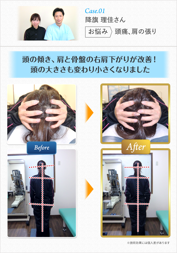 頭の傾き、方と骨盤の右肩下がりが改善!